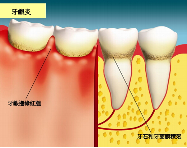 随着炎症的进一步扩散,牙周袋形成→牙周溢脓→牙齿松动→牙齿掉落