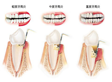 随着炎症的进一步扩散,牙周袋形成→牙周溢脓→牙齿松动→牙齿掉落