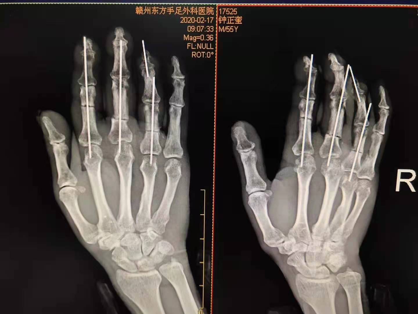 特殊类型的断指再植