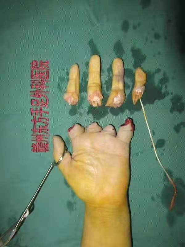 专业保肢减残