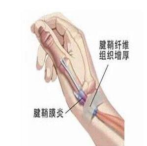 治疗腱鞘炎的3个小偏方