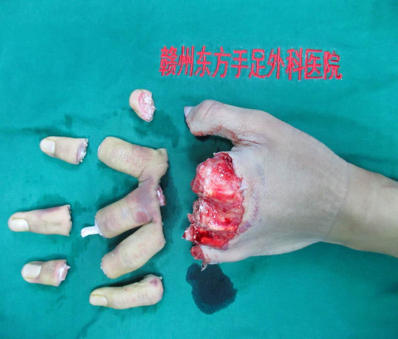 多指多段离断