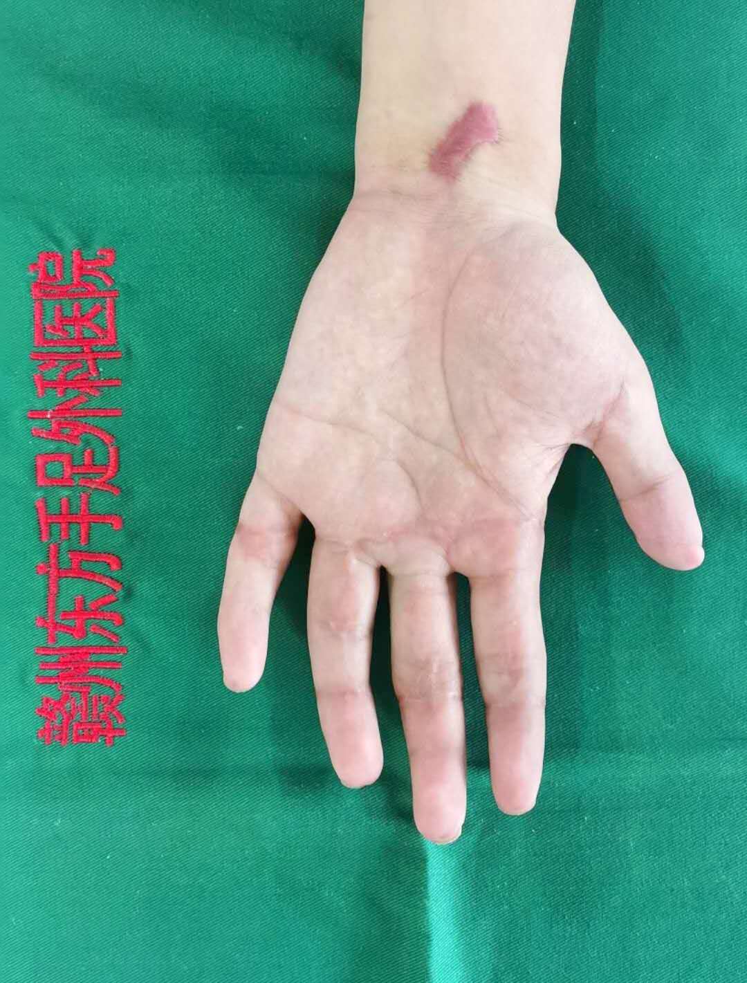 多指多段离断
