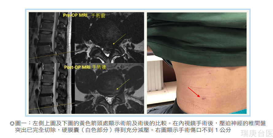 微創(chuàng)脊椎內(nèi)視鏡手術(shù)　小傷口解決骨刺及神經(jīng)壓迫造成的神經(jīng)痛