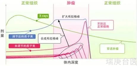 質(zhì)子治療腦膜瘤 | 腫瘤消失90%，3年無復(fù)發(fā)！