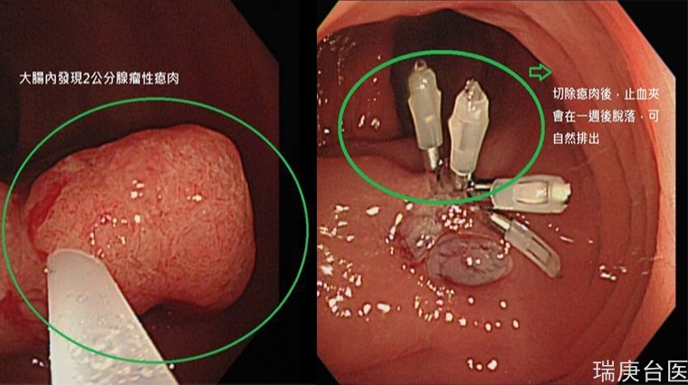 34歲無家族病史竟檢查出大腸癌 這些壞習(xí)慣種下禍根