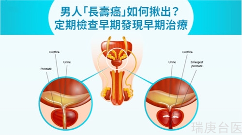 男人「長壽癌」如何揪出？ 定期檢查早期發(fā)現(xiàn)早期治療