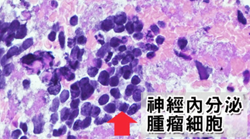 轉(zhuǎn)職健檢發(fā)現(xiàn)沉默腫瘤 這些名人也罹患神經(jīng)內(nèi)分泌瘤