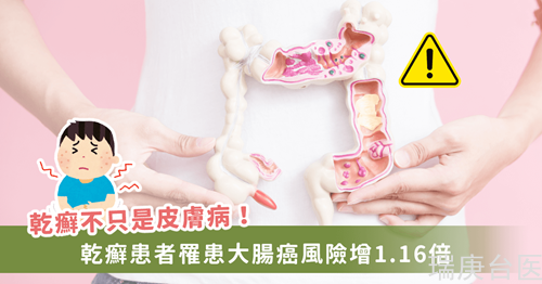 干癬患者罹患大腸癌風(fēng)險(xiǎn)增加1.16倍　