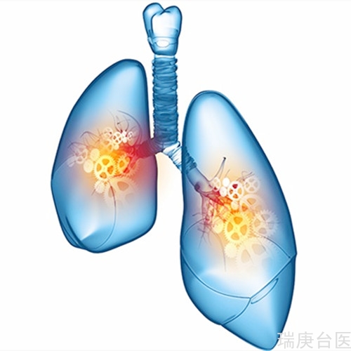 小細(xì)胞肺癌6成活不過1年 免疫療法開啟治療新契機(jī)