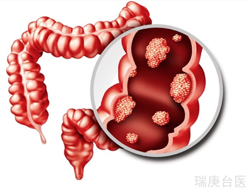預(yù)防大腸癌 醫(yī)師建議從這7招做起