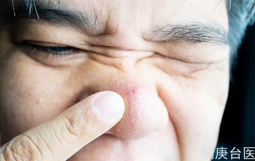 鼻子有個(gè)痘痘消不掉 沒想到是罕見鼻淋巴癌侵襲