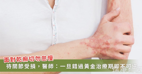 壓力大出現(xiàn)干癬性關(guān)節(jié)炎 醫(yī)師曝關(guān)鍵病癥：錯(cuò)過治療受損不可逆
