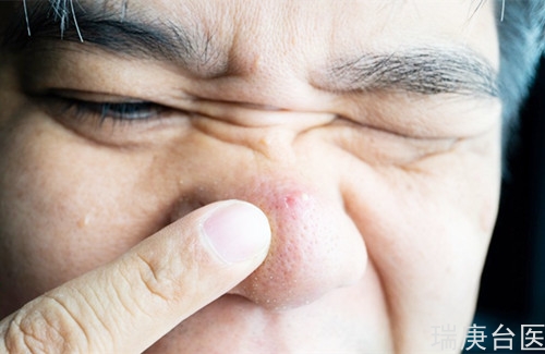 鼻子有個(gè)痘痘消不掉 沒想到是罕見鼻淋巴癌侵襲