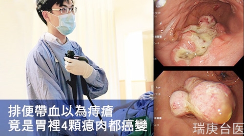 排便帶血以為痔瘡 竟是胃里4顆瘜肉都癌變