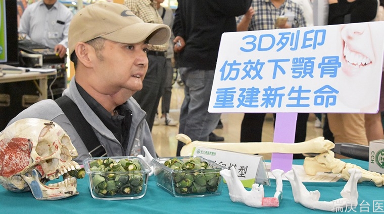 男子日嚼百顆檳榔罹舌癌 3D打印輔助找回顏面自信